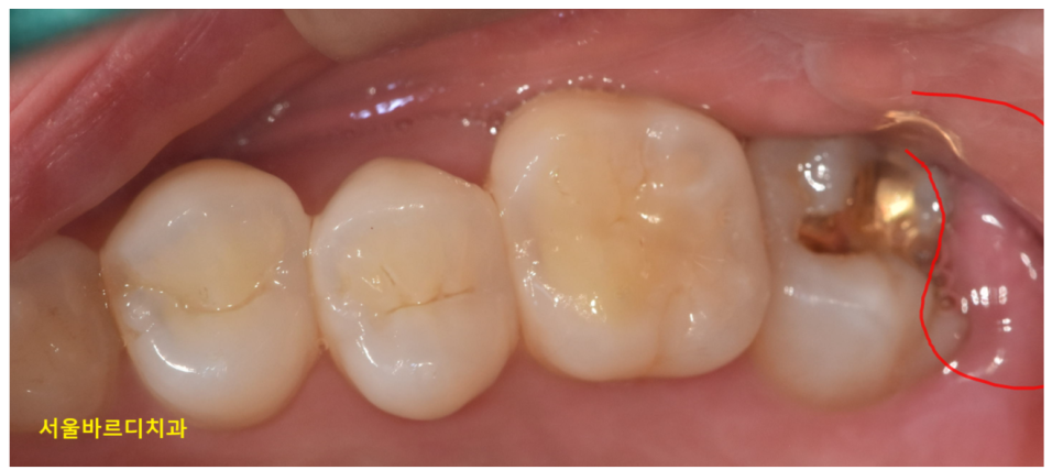 잇몸 곪음 피가 나오고 치통이 있을 때 관련 이미지 3