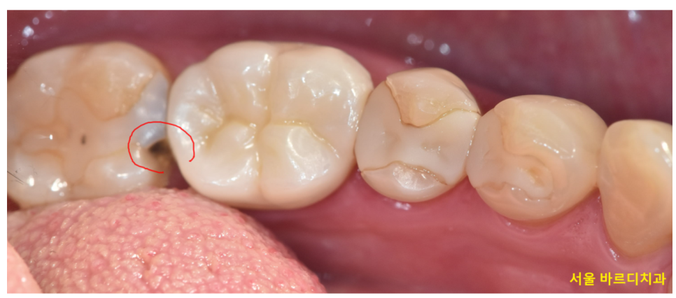 충치치료 후 이시림 자연스러운 반응일까 후유증일까? 관련 이미지 1