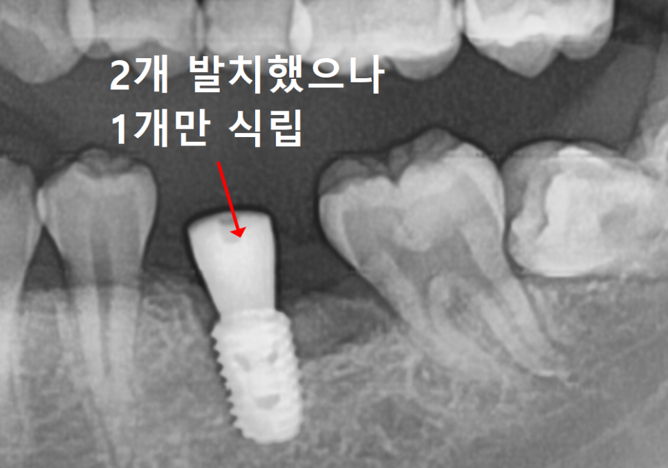 어금니 덧니 때문에 임플란트 해야 한다고요? 방치하면 안 되는 이유 관련 이미지 7