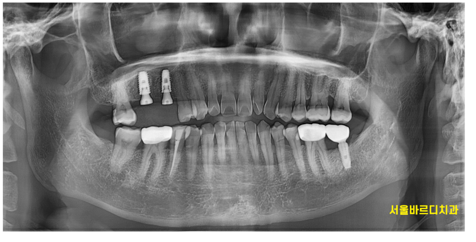 하남시청치과 신경치료 치아 발치 후 임플란트 했습니다. 관련 이미지 7