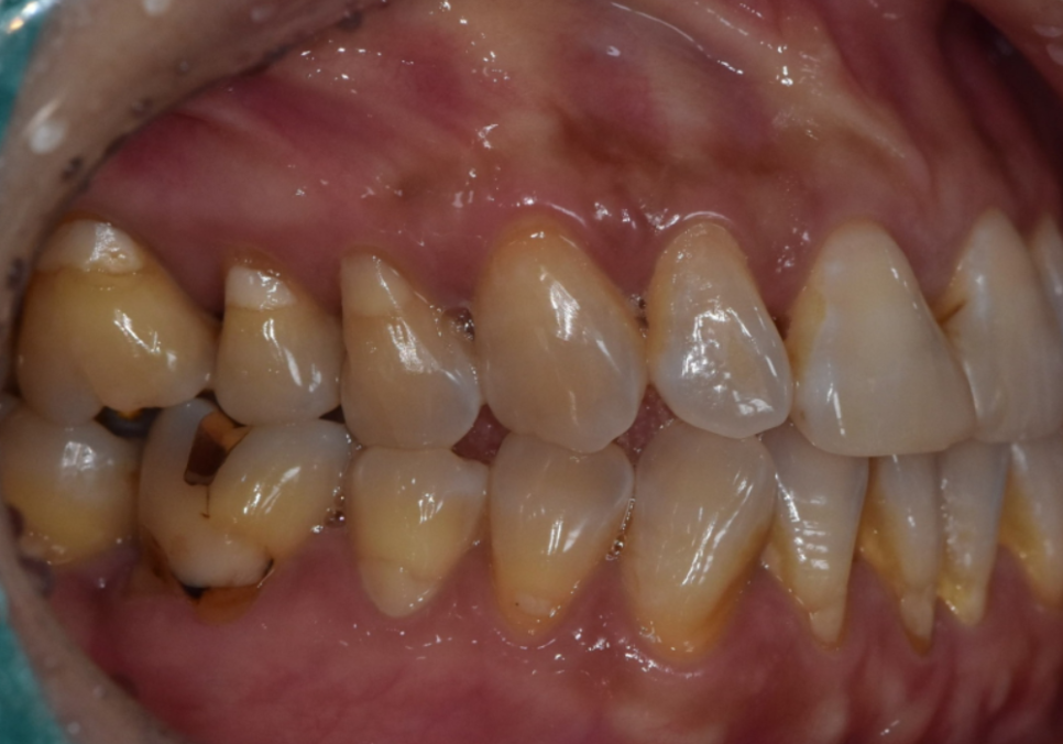 고덕동 치과 누런 이, 앞니 사이 틈, 잘못된 관리 때문일까? 관련 이미지 11