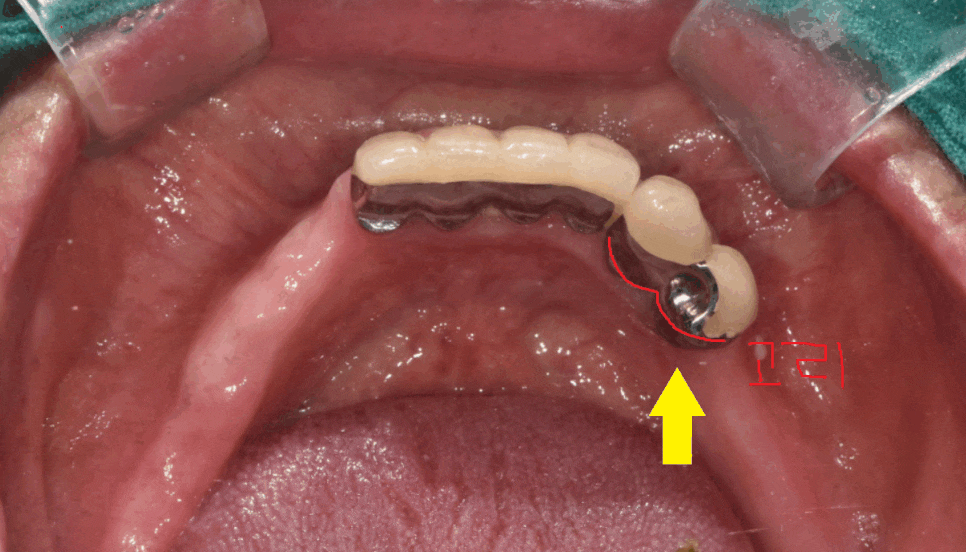 강일동 치과추천 틀니 사용중 치아 부러짐 임플란트로 복구했습니다. 관련 이미지 1