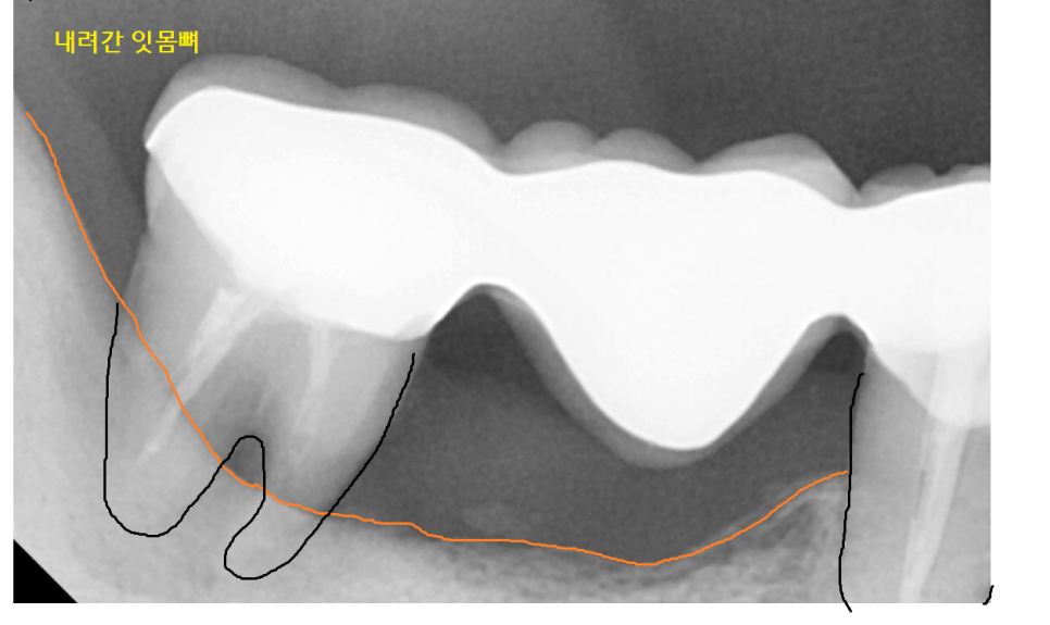 강일역 치과 치아와 임플란트 연결 가능한가요??? 관련 이미지 3