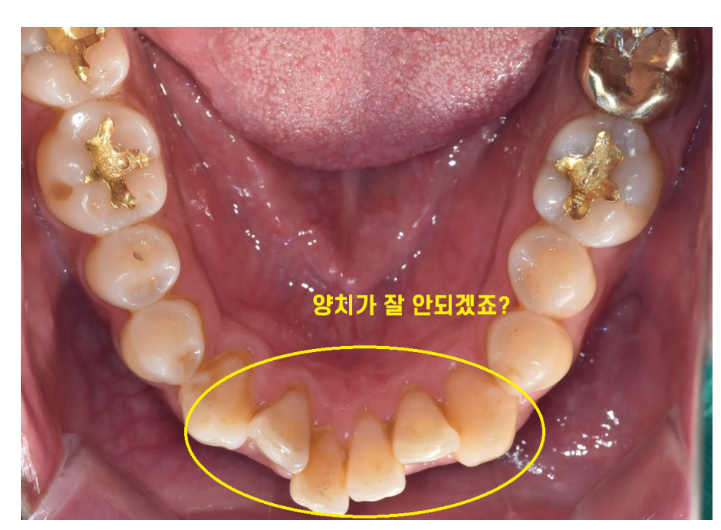 고덕동 교정 치과 성인 덧니 교정 지금도 늦지 않았습니다. 관련 이미지 4