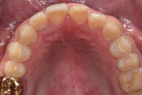 Gangdong-gu laminate failure and detachment: front teeth restored through retreatment image 5