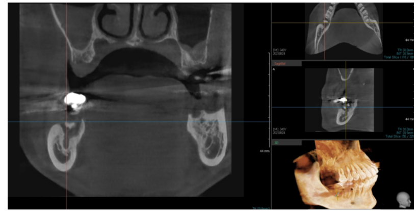 이 뽑고 바로 임플란트 심어도 될까요?? 관련 이미지 6