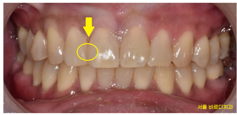 고덕 그라시움 치과 벌어진 앞니 메꾸기 당일 레진으로 치료했습니다. 관련 이미지 8