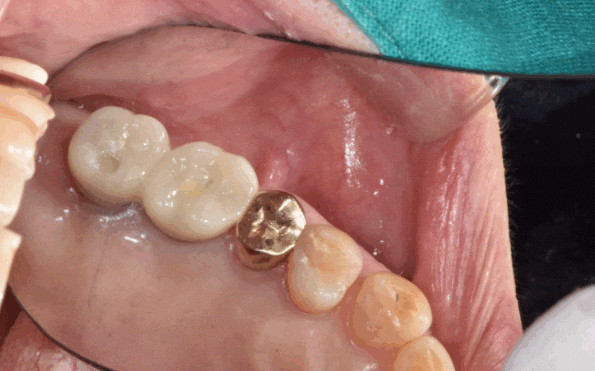 치아 크라운 빠짐 살릴 수 없을 때 강일역 임플란트 관련 이미지 1