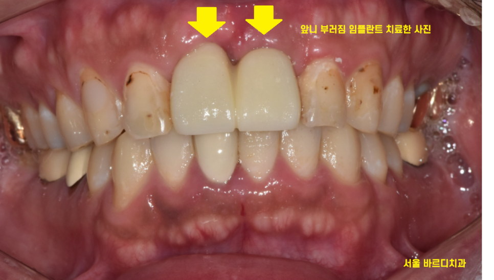 앞니 부러짐 손상이 커서 하남선동치과에서 임플란트 치료 관련 이미지 10