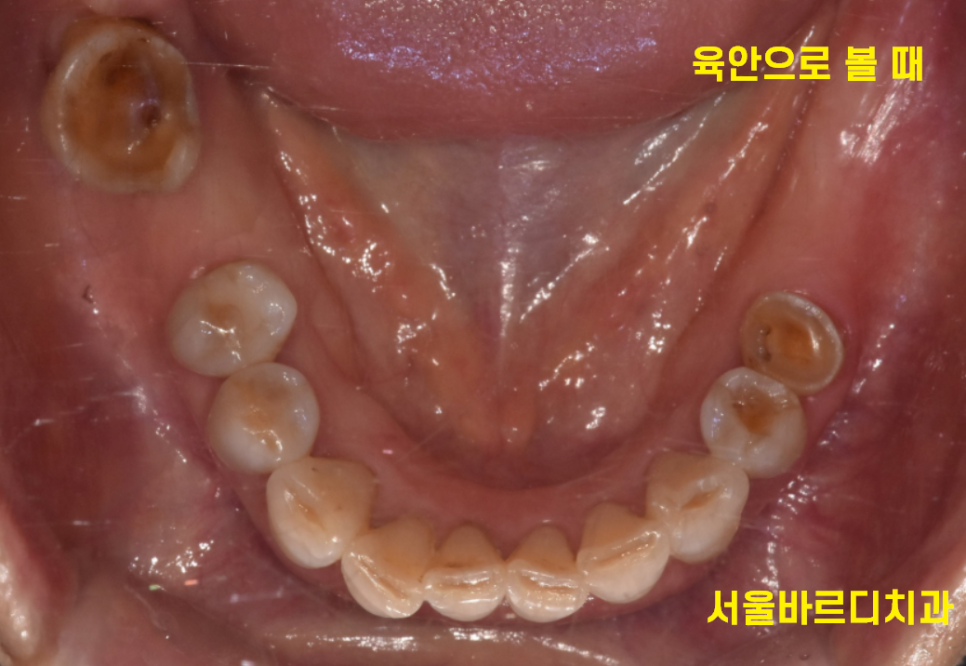 고덕동 치과 발치 후 방치하면 치아 쓰러짐 발생해요 관련 이미지 5