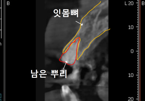 고덕동 앞니 보철, 브릿지와 싱글 크라운, 어떤 선택이 나에게 더 유리할까? 관련 이미지 15