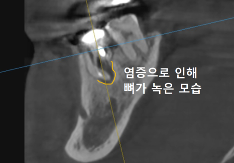 강동구 잇몸 여드름, 이런 상태라면 절대 겉에만 짜는 치료 하지 마세요. 관련 이미지 5