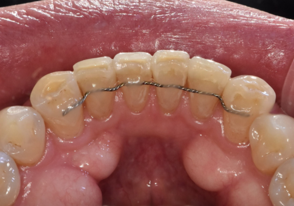 명일역 앞니 부분 교정, 치아 하나만 삐뚤어져 보인다면? 굳이 전체 교정할 필요 없습니다. 관련 이미지 11