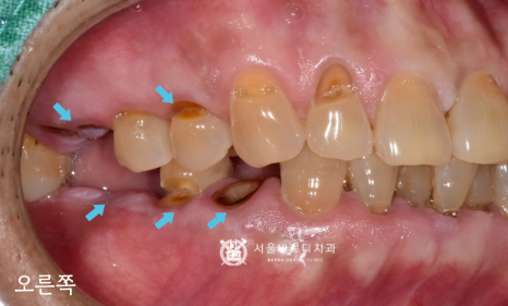 고덕동치과 서울바르디치과 무절개 네비게이션 임플란트 치료증례 #1 관련 이미지 3