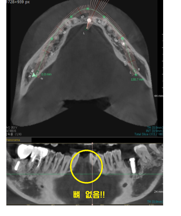 둔촌동 치과 아래 앞니 임플란트 뼈가 없을 때 일체형으로! 관련 이미지 5