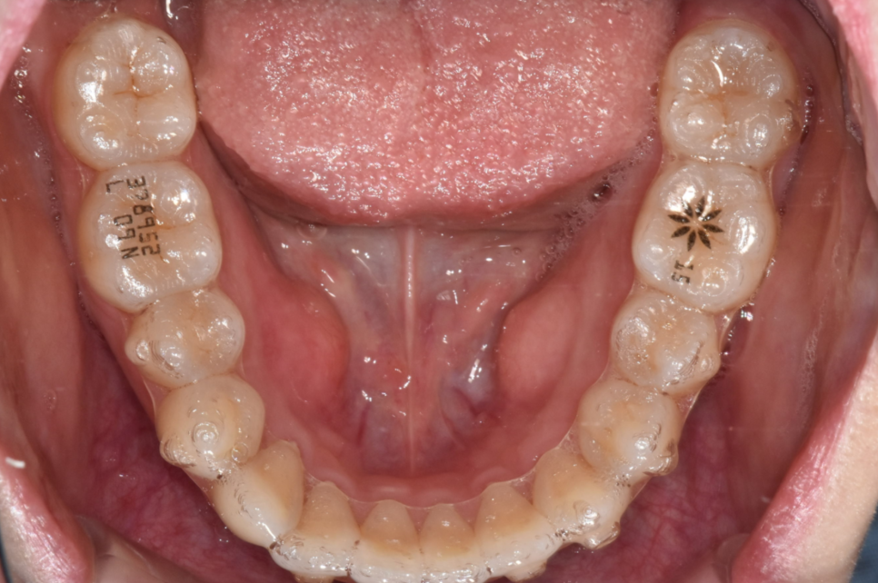 꼈다 뺐다 하는 교정 철사 붙이는건 옛말! 관련 이미지 3