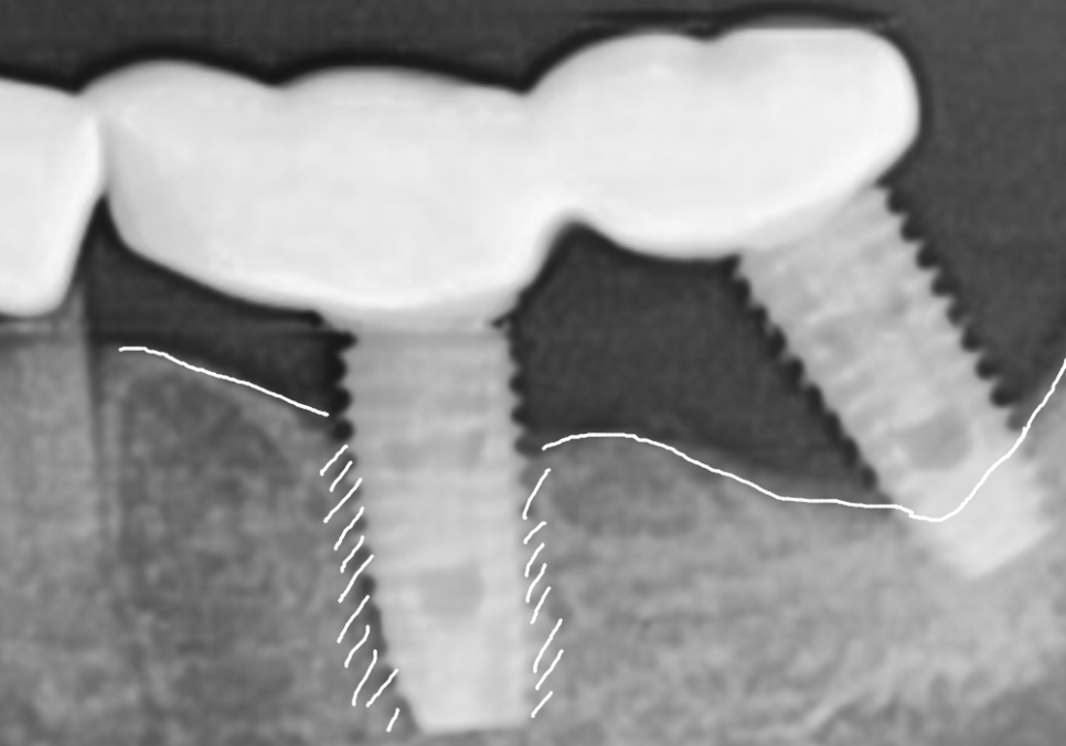 천호동 임플란트 재식립 사례, 평생 쓰는 줄 알았는데? 관련 이미지 10
