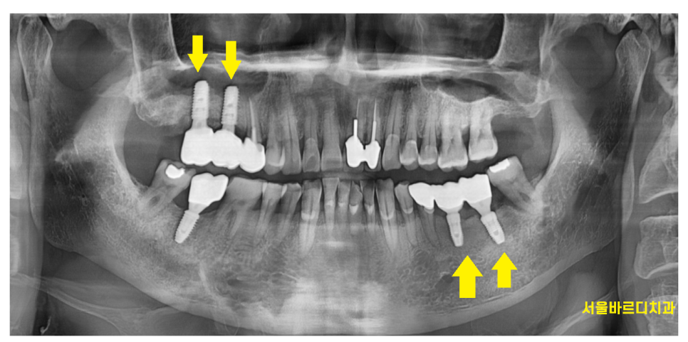 고덕동 임플란트 크라운 연결해서 만드는 이유는? 관련 이미지 4