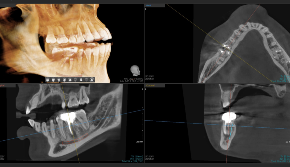 고덕동 20대 임플란트, 시기 놓치면 비용 2배 이상 듭니다. 관련 이미지 7