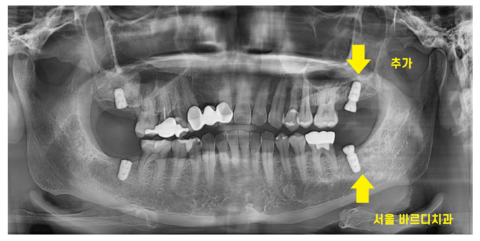 명일동 치과 임플란트 위아래 같이 한꺼번에 할 수 있나요?? 관련 이미지 6