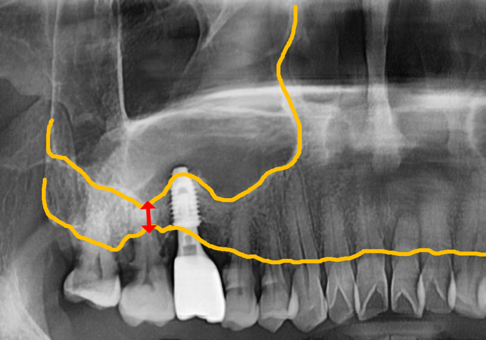 고덕동 어금니 브릿지 교체, 관련 이미지 8