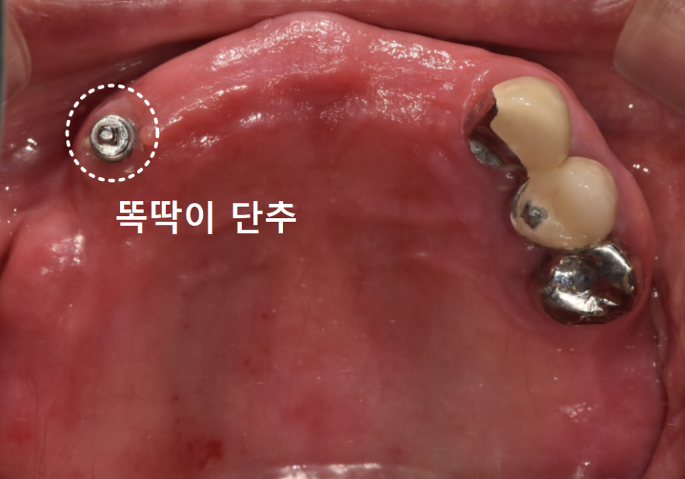 강동구 똑딱이 틀니, 정말 만능일까요? 식사할 때마다 들썩거리는 이유 관련 이미지 13