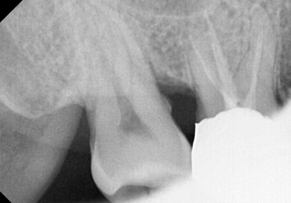 시큰거리는 통증, 시린 이 치약으로 해결 안 된다고요? 관련 이미지 7