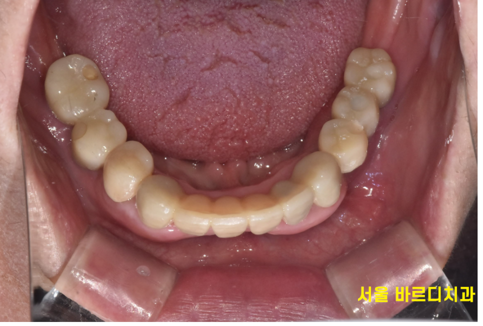 전체적인 치아 치료 13개의 임플란트를 식립한 환자분 관련 이미지 15
