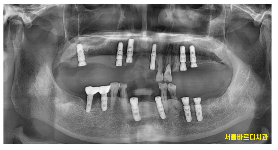 천호동 치과 자연 발치 후 방치된 치아 임플란트 케이스 관련 이미지 9