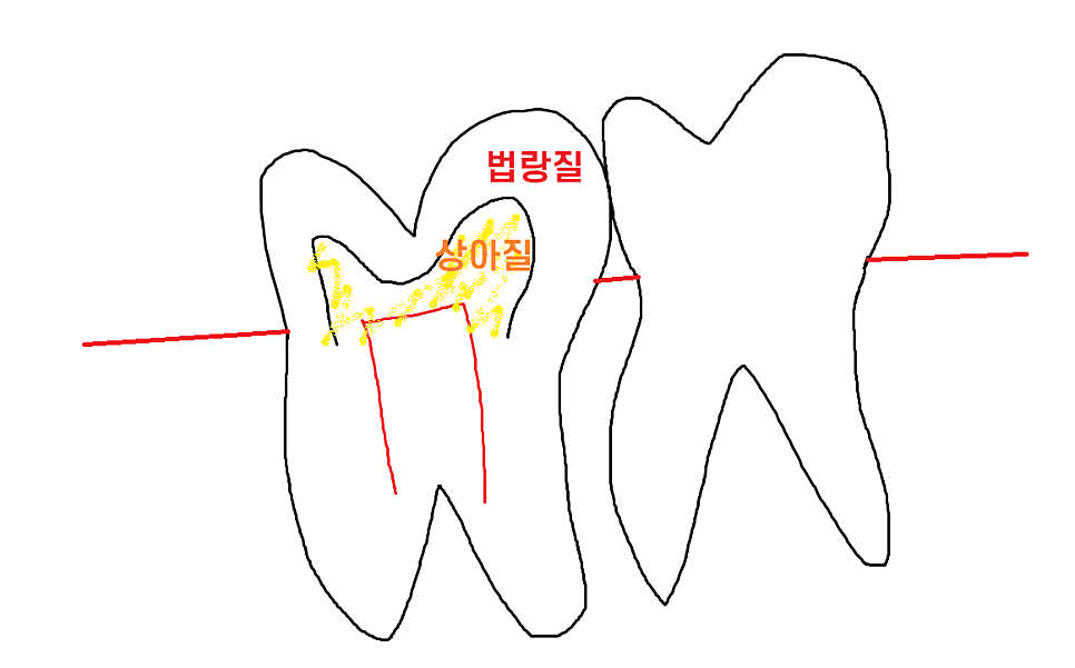 치실 안쓰면 이렇게 됩니다!!  치아 사이 충치 인레이 치료 관련 이미지 5