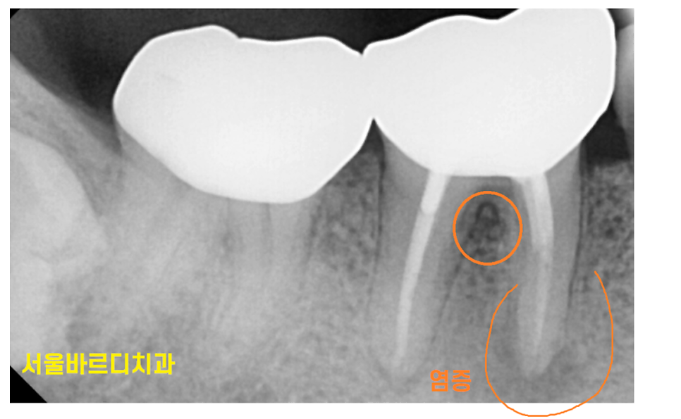 잇몸 곪음 피가 나오고 치통이 있을 때 관련 이미지 5