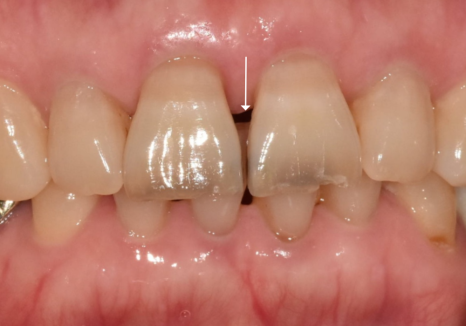 마모된 윗 앞니가 까맣게 변했다면? 방치하면 안 되는 이유 관련 이미지 9