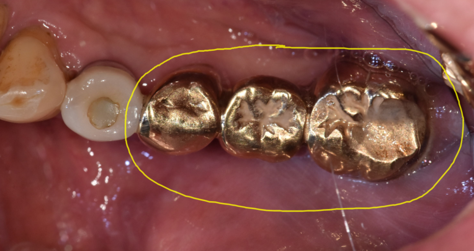 치아 상실 치료 치과 브릿지? 임플란트? 무엇이든 시도하세요. 관련 이미지 7
