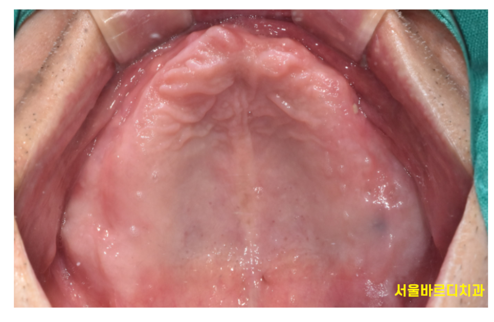틀니 쓰다가 임플란트 어려움은 ? 높이를 높여주는게 킥!!! 관련 이미지 2