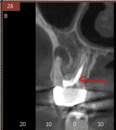 발치 대신 신경치료 뽑기 전 치료는 한번 해봐야하지않을까요? 관련 이미지 5