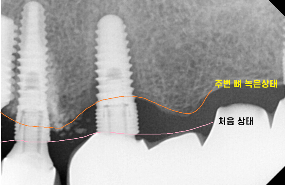 임플란트 잇몸 염증 반복되면 재수술도 필요합니다. 관련 이미지 2