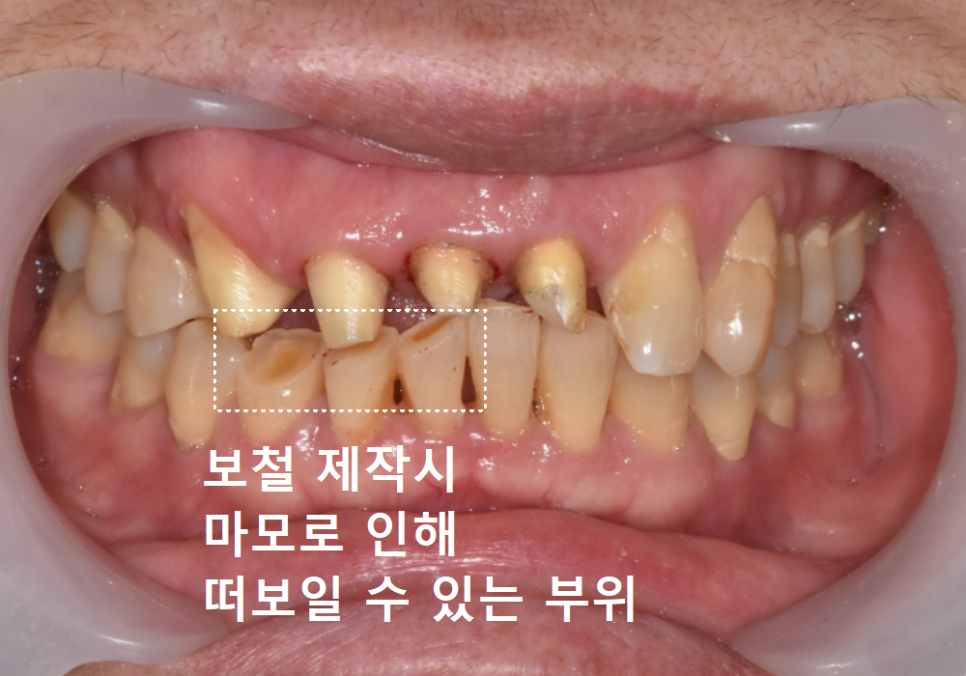 고덕동 심미 보철, 삐뚤어진 앞니, 교정 없이 바로잡은 비결 관련 이미지 12
