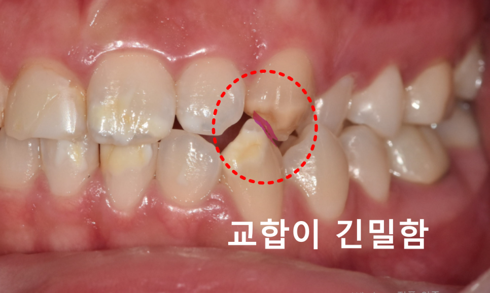 강동구 라미네이트, 치아 하얀 반점 없애고 싶다면? 치료 방법 관련 이미지 8