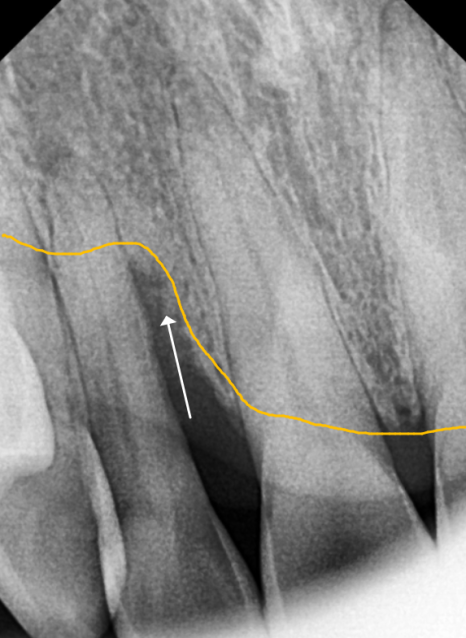 고덕동 스케일링 미루다 앞니 어금니 다 뽑고 임플란트 했습니다. 관련 이미지 3