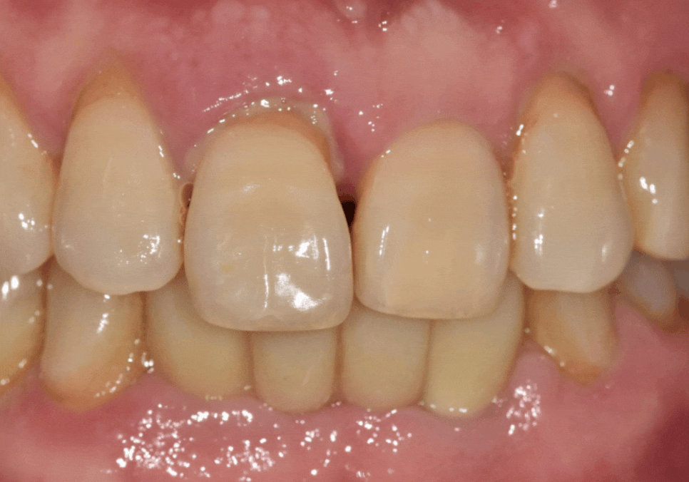 앞니 길어짐, 위 앞니가 점점 내려온다면? 관련 이미지 15