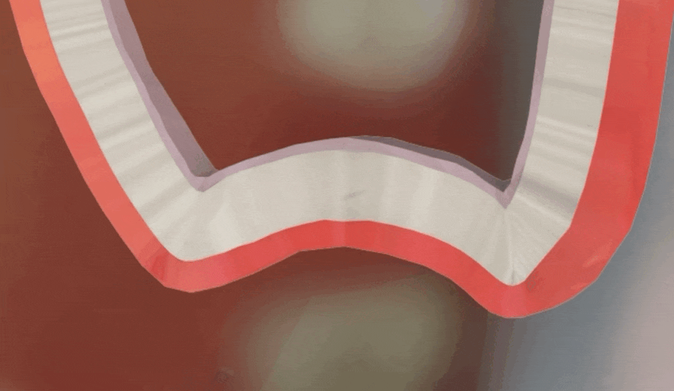 얇은 잇몸뼈, 임플란트 거부 당했다면? 상악동거상술로 해결할 수 있습니다. 관련 이미지 5