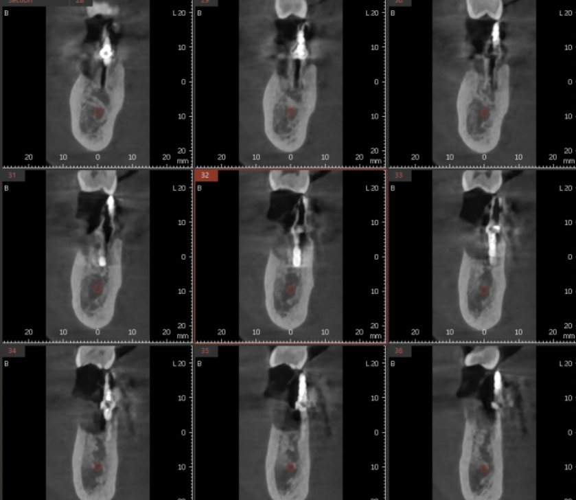 고덕동 임플란트 골이식 필수일까? 궁금증 여기 모두 있어요 관련 이미지 4