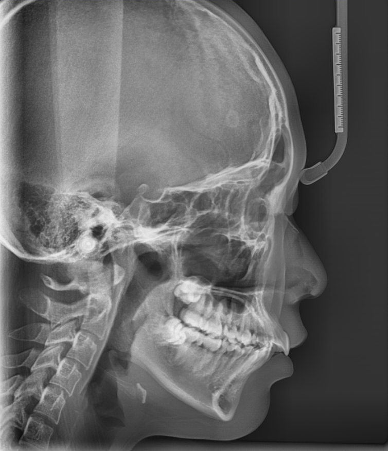 상일동 치아 교정 고려해봐야할 2가지 요소 관련 이미지 3