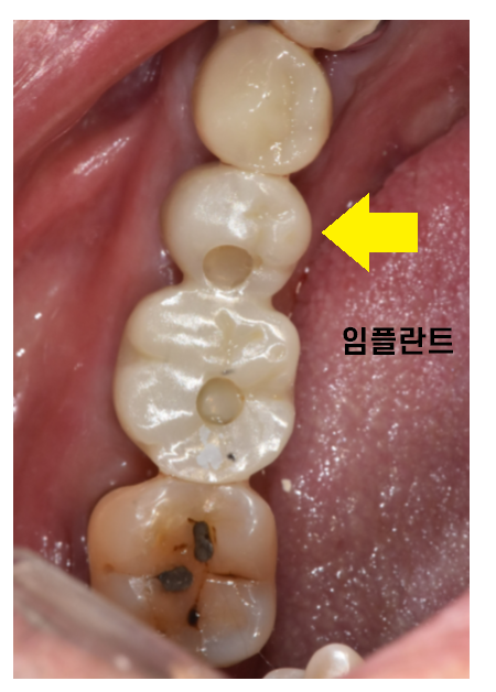 하남시청치과 치아 욱신거림 임플란트로 치료해드렸습니다. 관련 이미지 10
