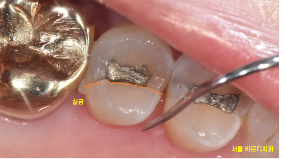 초이동 치과 치아 실금으로 조각나 신경치료까지 진행했습니다. 관련 이미지 3