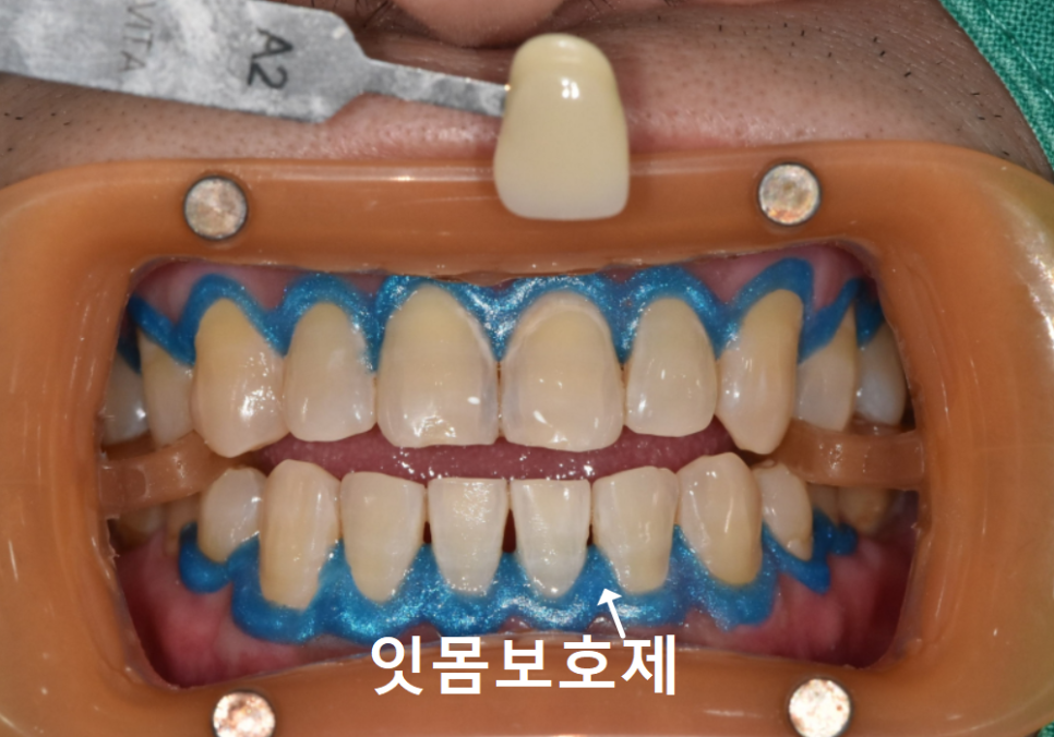 명일동 치과, 미백하면 연예인 치아처럼 새하얘진다는 말, 저는 못하겠습니다. 관련 이미지 7