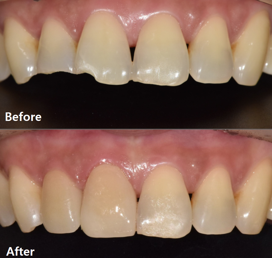 깨진 앞니 심미 치료, 라미네이트 vs 지르코니아 어떤 선택이 더 나을까? 관련 이미지 11