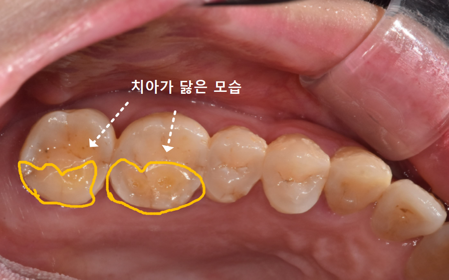 아침에 일어날 때 어금니가 욱신거린다면? 이 습관을 의심해 봐야 합니다. 관련 이미지 1