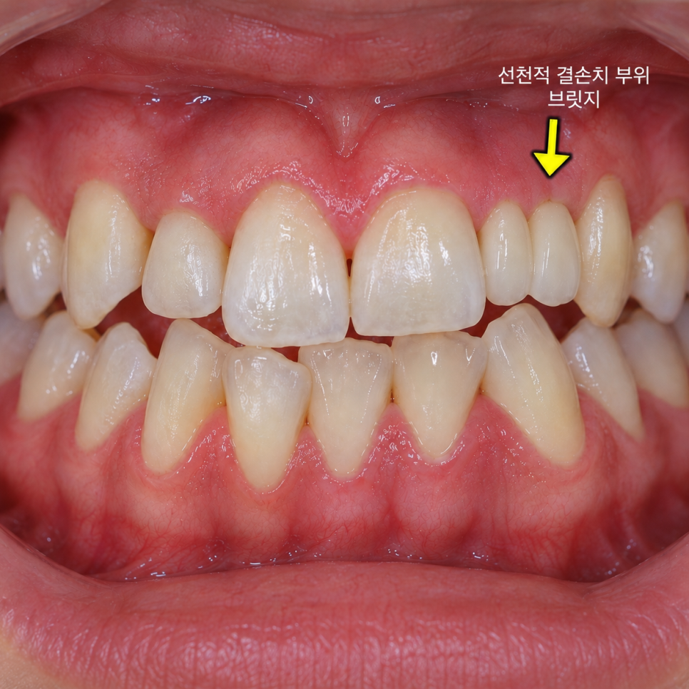 상일동 선천적 결손치로 벌어진 앞니 치아, 교정 말고 방법 없을까요? 관련 이미지 4