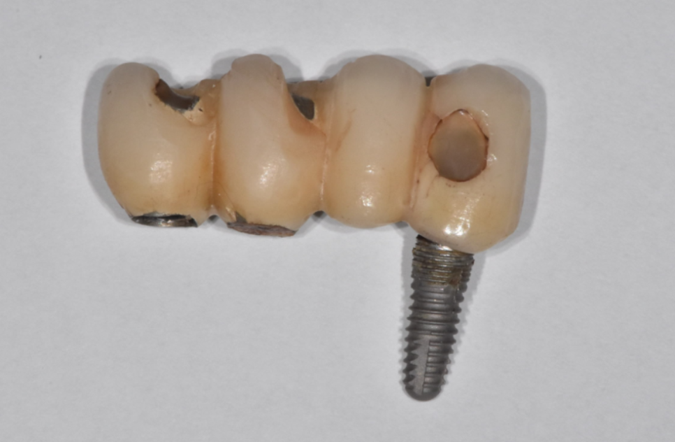 둔촌동 치과 임플란트 평균 수명 이것이 진짜 진실입니다 관련 이미지 4